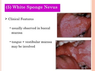 (5) White Sponge Nevus

 Clinical Features

   • usually observed in buccal
    mucosa

   • tongue + vestibular mucosa
    may be involved
 