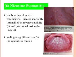 (6) Nicotine Stomatitis

 combination of tobacco
  carcinogens + heat is markedly
  intensified in reverse smoking
  (lit end positioned inside the
   mouth)

 adding a significant risk for
  malignant conversion
 