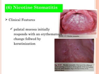 (6) Nicotine Stomatitis

 Clinical Features

    palatal mucosa initially
     responds with an erythematous
     change follwed by
     keratinization
 