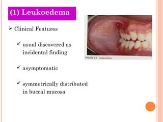 (1) Leukoedema

 Clinical Features

    usual discovered as
     incidental finding

    asymptomatic

    symmetrically distributed
     in buccal mucosa
 
