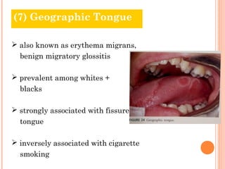 (7) Geographic Tongue

 also known as erythema migrans,
  benign migratory glossitis

 prevalent among whites +
  blacks

 strongly associated with fissure
  tongue

 inversely associated with cigarette
  smoking
 