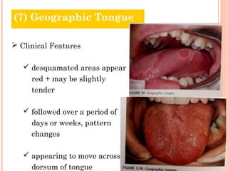 (7) Geographic Tongue

 Clinical Features

    desquamated areas appear
     red + may be slightly
     tender

    followed over a period of
     days or weeks, pattern
     changes

    appearing to move across
     dorsum of tongue
 