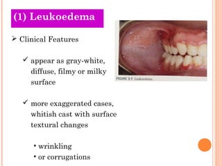 (1) Leukoedema

 Clinical Features

    appear as gray-white,
     diffuse, filmy or milky
     surface

    more exaggerated cases,
     whitish cast with surface
     textural changes

      • wrinkling
      • or corrugations
 