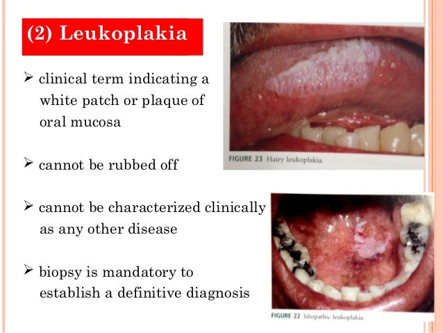 White Oral Lesion 110