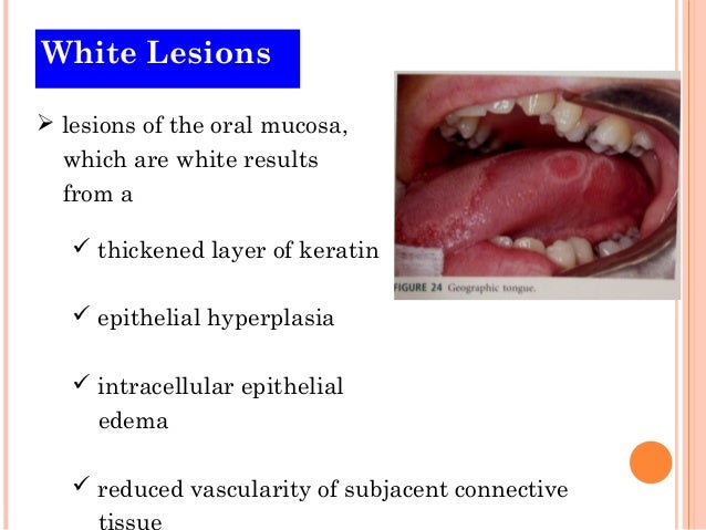 White Oral Lesion 118