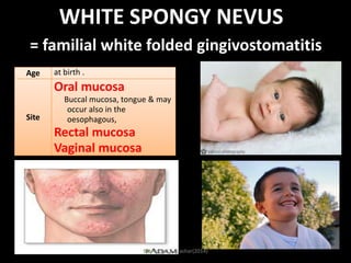 WHITE SPONGY NEVUS
= familial white folded gingivostomatitis
Age

at birth .

Oral mucosa
Site

Buccal mucosa, tongue & may
occur also in the
oesophagous,

Rectal mucosa
Vaginal mucosa

Dr. Ahmed E-lNashar(2014)

 