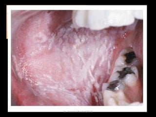 Bilateral symetrical
The mucosa appears
 thickened
 folded or corrugated
 spongy texture and
 a peculiar white opalescent hue.

Dr. Ahmed E-lNashar(2014)

 