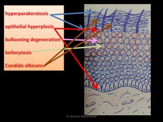 hyperparakeratosis
epithelial hyperplasia
ballooning degeneration
koilocytosis
Candida albicans

Dr. Ahmed E-lNashar(2014)

 