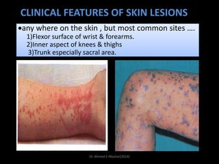 CLINICAL FEATURES OF SKIN LESIONS
any where on the skin , but most common sites ….
1)Flexor surface of wrist & forearms.
2)Inner aspect of knees & thighs
3)Trunk especially sacral area.

Dr. Ahmed E-lNashar(2014)

 