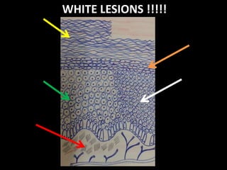 WHITE LESIONS !!!!!

Dr. Ahmed E-lNashar(2014)

 