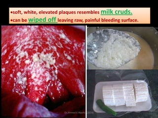 soft, white, elevated plaques resembles milk

cruds.

can be wiped off leaving raw, painful bleeding surface.

Dr. Ahmed E-lNashar(2014)

 
