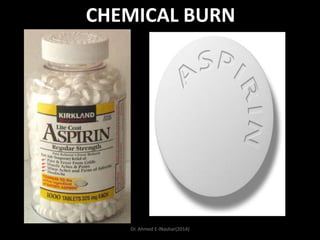 CHEMICAL BURN

Dr. Ahmed E-lNashar(2014)

 