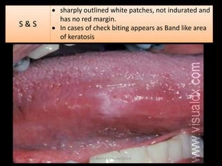 S&S

sharply outlined white patches, not indurated and
has no red margin.
In cases of check biting appears as Band like area
of keratosis

Dr. Ahmed E-lNashar(2014)

 