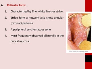 White Lesions of Oral Cavity LICHEN PLANUS.pptx