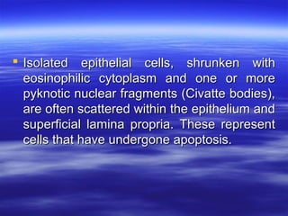  Isolated epithelial cells, shrunken with
eosinophilic cytoplasm and one or more
pyknotic nuclear fragments (Civatte bodies),
are often scattered within the epithelium and
superficial lamina propria. These represent
cells that have undergone apoptosis.

 