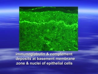 immunoglobulin & complement
deposits at basement membrane
:zone & nuclei of epithelial cells

 