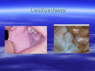 Leukoedema

 