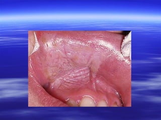 White lesions ppt