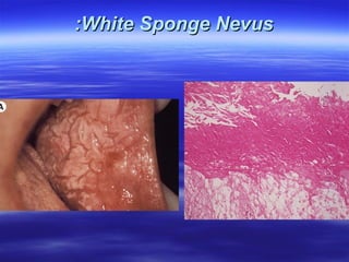 :White Sponge Nevus

 