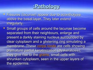 :Pathology
 Fissures (lacunae) appear due to acantholysis
above the basal layer. They later extend
irregularly.
 Small groups of cells around the lacunae become
separated from their neighbours, enlarge and
present a darkly staining nucleus surrounded by
clear cytoplasm and a glistening ring simulating a
membrane. These corps ronds are cells showing
premature partial keratinization (dyskeratosis);
they give rise to the grains, small cells with
shrunken cytoplasm, seen in the upper layers of
the epidermis.

 
