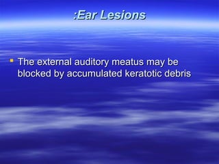 :Ear Lesions

 The external auditory meatus may be
blocked by accumulated keratotic debris

 