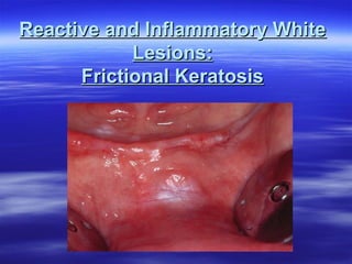 Reactive and Inflammatory White
Lesions:
Frictional Keratosis

 