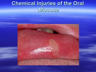 Chemical Injuries of the Oral
:Mucosa

 