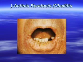 (:Actinic Keratosis (Cheilitis

 