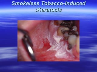 Smokeless Tobacco-lnduced
:Keratosis

 