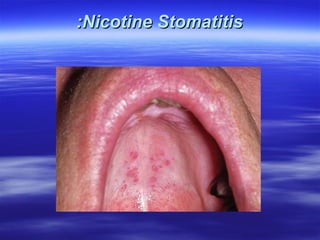 :Nicotine Stomatitis

 