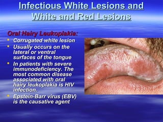 Infectious White Lesions and
White and Red Lesions
Oral Hairy Leukoplakia:
 Corrugated white lesion
 Usually occurs on the
lateral or ventral
surfaces of the tongue
 In patients with severe
immunodeficiency. The
most common disease
associated with oral
hairy leukoplakia is HIV
infection.
 Epstein-Barr virus (EBV(
is the causative agent

 