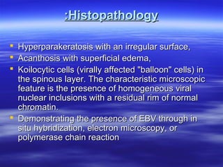 :Histopathology
 Hyperparakeratosis with an irregular surface,
 Acanthosis with superficial edema,
 Koilocytic cells (virally affected "balloon" cells) in
the spinous layer. The characteristic microscopic
feature is the presence of homogeneous viral
nuclear inclusions with a residual rim of normal
chromatin.
 Demonstrating the presence of EBV through in
situ hybridization, electron microscopy, or
polymerase chain reaction

 