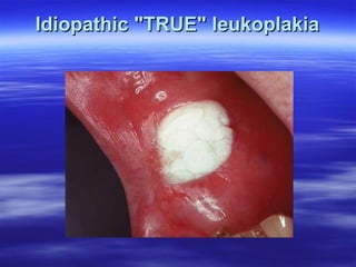 Idiopathic "TRUE" leukoplakia

 