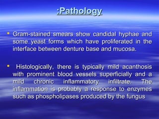 :Pathology
 Gram-stained smears show candidal hyphae and
some yeast forms which have proliferated in the
interface between denture base and mucosa.


Histologically, there is typically mild acanthosis
with prominent blood vessels superficially and a
mild
chronic
inflammatory
infiltrate.
The
inflammation is probably a response to enzymes
such as phospholipases produced by the fungus

 
