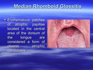 . Median Rhomboid Glossitis
 Erythematous patches
of atrophic papillae
located in the central
area of the dorsum of
the
tongue
are
considered a form of
chronic
atrophic
candidiasis.

 