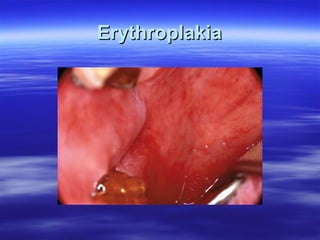 Erythroplakia

 