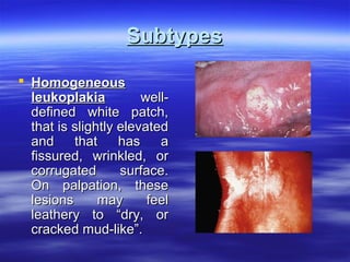 Subtypes
 Homogeneous
leukoplakia
welldefined white patch,
that is slightly elevated
and
that
has
a
fissured, wrinkled, or
corrugated
surface.
On palpation, these
lesions
may
feel
leathery to “dry, or
cracked mud-like”.

 