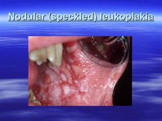 Nodular (speckled) leukoplakia

 