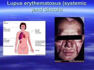 Lupus erythematosus (systemic
)and discoid

 