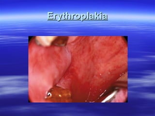 Erythroplakia

 