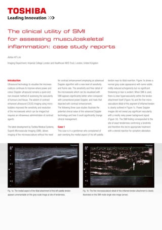 Introduction
Ultrasound technology to visualise the microvas-
culature continues to improve where power and
colour Doppler ultrasound remains a quick and
non-invasive method of assessing the vascularity
of tumours and tissue. The advent of contrast
enhanced ultrasound (CEUS) imaging using micro­
bubbles improved the sensitivity and resolution
of the microvessels which can be imaged but
requires an intravenous administration of contrast
agents.
The latest development by Toshiba Medical Systems,
Superb Microvascular Imaging (SMI), allows
imaging of the microvasculature without the need
for contrast enhancement employing an advanced
Doppler algorithm with a new level of sensitivity
and frame rate. The sensitivity and finer detail of
the microvessels which can be visualised with
SMI appears significantly better when compared
with conventional power Doppler, and rivals that
depicted with contrast enhancement.
The following three case studies illustrate the
potential clinical value of this advanced Doppler
technology and how it could significantly change
clinical management.
Case 1
This case is in a gentleman who complained of
pain overlying the medial aspect of his left patella
tendon near its tibial insertion. Figure 1a shows a
normal grey-scale appearance with some subtle,
mildly reduced echogenicity but no significant
thickening or tear is evident. When SMI is used,
there is clear hypervascularity within the tendon
attachment itself (Figure 1b) and the fine micro-
vasculature detail of this segment of inflamed tendon
is clearly outlined in Figure 1c. Power Doppler
images did not reveal any significant vascularity
with a mostly noisy power background signal
(Figure 1d). The SMI finding corresponded to the
site of exact tenderness confirming a tendinitis
and therefore this led to appropriate treatment
with a steroid injection for symptom alleviation.
Adrian KP Lim
Imaging Department, Imperial College London and Healthcare NHS Trust, London, United Kingdom
The clinical utility of SMI
for assessing musculoskeletal
inflammation: case study reports
Fig. 1b: The fine microvasculature detail of this inflamed tendon attachment is clearly
illustrated on this SMI mode single view image (arrow).
Fig. 1a: The medial aspect of the tibial attachment of this left patella tendon
appears unremarkable on this grey-scale image at site of tenderness.
 