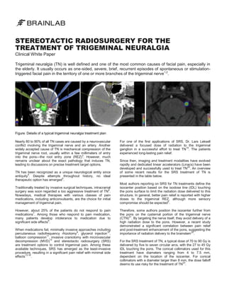 STEREOTACTIC RADIOSURGERY FOR THE
TREATMENT OF TRIGEMINAL NEURALGIA
Clinical White Paper

Trigeminal neuralgia (TN) is well defined and one of the most common causes of facial pain, especially in
the elderly. It usually occurs as one-sided, severe, brief, recurrent episodes of spontaneous or stimulationtriggered facial pain in the territory of one or more branches of the trigeminal nerve 1,2.

Figure: Details of a typical trigeminal neuralgia treatment plan
Nearly 80 to 90% of all TN cases are caused by a neurovascular
conflict involving the trigeminal nerve and an artery. Another
widely accepted cause of TN is mechanical compression of the
trigeminal nerve root, usually within a few millimeters of entry
3
into the pons—the root entry zone (REZ) . However, much
remains unclear about the exact pathology that induces TN,
leading to discussions on precise treatment target options.
TN has been recognized as a unique neurological entity since
4
antiquity . Despite attempts throughout history, no ideal
5
therapeutic option has emerged .
Traditionally treated by invasive surgical techniques, intracranial
surgery was soon regarded a too aggressive treatment of TN6.
Nowadays, medical therapies with various classes of pain
medications, including anticonvulsants, are the choice for initial
management of trigeminal pain.
However, about 25% of the patients do not respond to pain
medications7. Among those who respond to pain medication,
many patients develop intolerance to medication due to
significant side effects8.
When medications fail, minimally invasive approaches including
9
10
percutaneous radiofrequency rhizotomy , glycerol injection ,
11
balloon compression , invasive craniotomy with microvascular
12
decompression (MVD) and stereotactic radiosurgery (SRS)
are treatment options to control trigeminal pain. Among these
available techniques, SRS has emerged as the least-invasive
procedure, resulting in a significant pain relief with minimal side
effects13-18.

For one of the first applications of SRS, Dr. Lars Leksell
delivered a focused dose of radiation to the trigeminal
ganglion in a successful effort to treat TN19. The patients
experienced long-lasting pain relief.
Since then, imaging and treatment modalities have evolved
rapidly and dedicated linear accelerators (Linacs) have been
20
developed and successfully used to treat TN . An overview
of some recent results for the SRS treatment of TN is
presented in the table below.
Most authors reporting on SRS for TN treatments define the
isocenter position based on the isodose line (IDL) touching
the pons surface to limit the radiation dose delivered to this
structure. In general, better pain relief is reported with higher
doses to the trigeminal REZ, although more sensory
5
compromise should be expected .
Therefore, some authors position the isocenter further from
the pons on the cysternal portion of the trigeminal nerve
21
(CTN) . By targeting the nerve itself, they avoid delivery of a
high radiation dose to the pons. However, a recent study
demonstrated a significant correlation between pain relief
and post-treatment enhancement of the pons, suggesting the
22
importance of radiation delivery to the brainstem .
For the SRS treatment of TN, a typical dose of 70 to 90 Gy is
delivered by five to seven circular arcs, with the 27 to 45 Gy
IDL touching the pons. The conical collimators used for this
treatment have diameters ranging from 4 to 7.5 mm,
dependent on the location of the isocenter. For conical
collimators with a diameter larger than 8 mm, the dose falloff
23
deems its use risky for the treatment of TN .

 