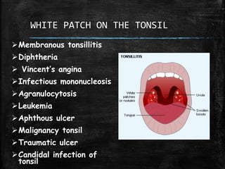 WHITE PATCH ON THE TONSIL
Membranous tonsillitis
Diphtheria
 Vincent’s angina
Infectious mononucleosis
Agranulocytosis
Leukemia
Aphthous ulcer
Malignancy tonsil
Traumatic ulcer
Candidal infection of
tonsil
 