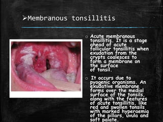 Membranous tonsillitis
o Acute membranous
tonsillitis. It is a stage
ahead of acute
follicular tonsillitis when
exudation from the
crypts coalesces to
form a membrane on
the surface
of tonsil.
o It occurs due to
pyogenic organisms. An
exudative membrane
forms over the medial
surface of the tonsils,
along with the features
of acute tonsillitis, like
red and swollen tonsils
with marked hyperaemia
of the pillars, uvula and
soft palate.
 
