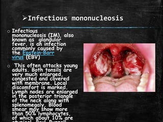Infectious mononucleosis
o Infectious
mononucleosis (IM), also
known as glandular
fever, is an infection
commonly caused by
the Epstein–Barr
virus (EBV)
o This often attacks young
adults. Both tonsils are
very much enlarged,
congested and covered
with membrane. Local
discomfort is marked.
Lymph nodes are enlarged
in the posterior triangle
of the neck along with
splenomegaly. Blood
smear may show more
than 50% lymphocytes,
of which about 10% are
 