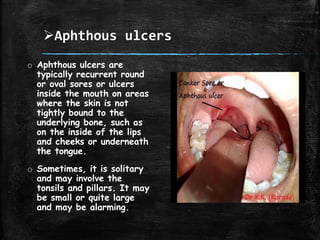 Aphthous ulcers
o Aphthous ulcers are
typically recurrent round
or oval sores or ulcers
inside the mouth on areas
where the skin is not
tightly bound to the
underlying bone, such as
on the inside of the lips
and cheeks or underneath
the tongue.
o Sometimes, it is solitary
and may involve the
tonsils and pillars. It may
be small or quite large
and may be alarming.
 