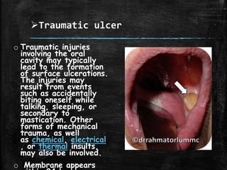 Traumatic ulcer
o Traumatic injuries
involving the oral
cavity may typically
lead to the formation
of surface ulcerations.
The injuries may
result from events
such as accidentally
biting oneself while
talking, sleeping, or
secondary to
mastication. Other
forms of mechanical
trauma, as well
as chemical, electrical
, or thermal insults,
may also be involved.
o Membrane appears
 