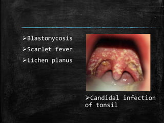 Candidal infection
of tonsil
Blastomycosis
Scarlet fever
Lichen planus
 