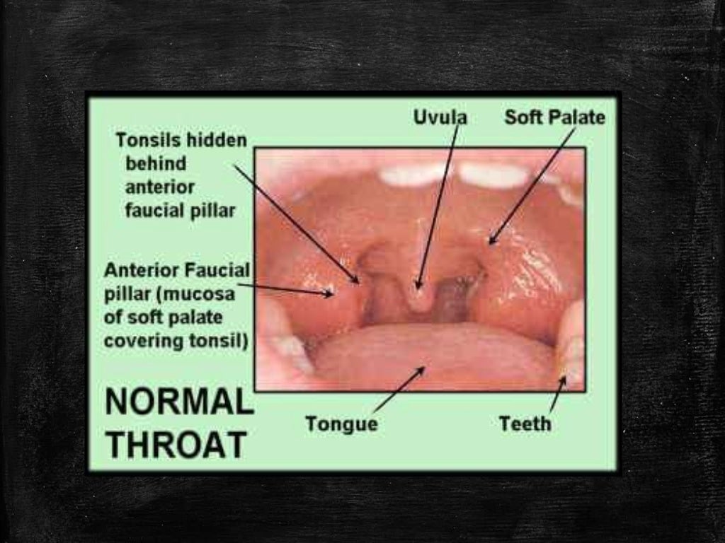 White Patch On The Tonsil Differential Diagnosis