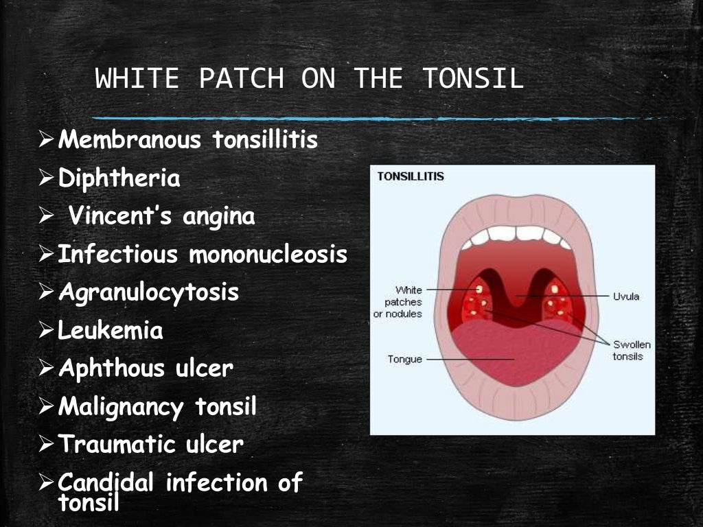 White Patch On The Tonsil Differential Diagnosis